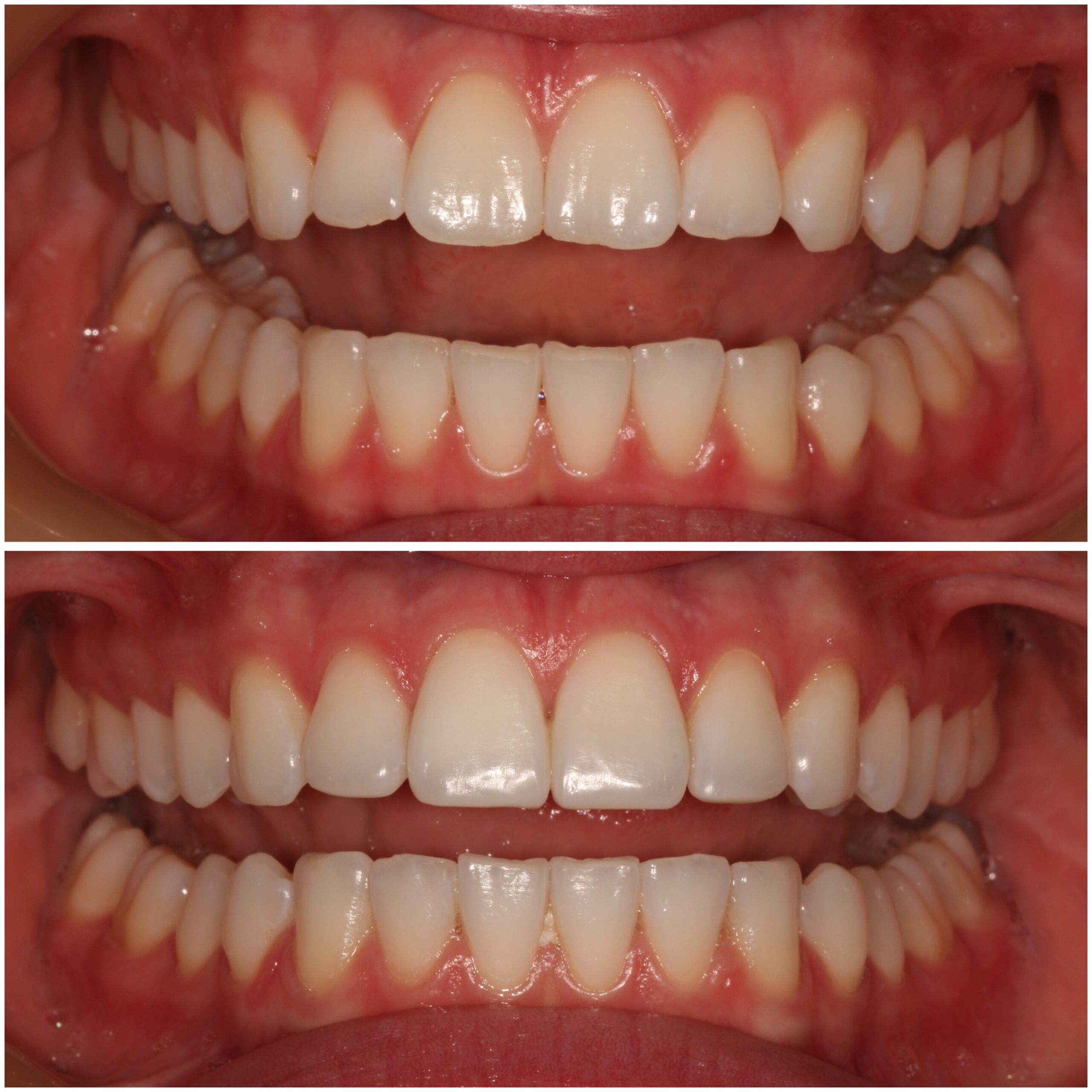 Teeth Straightening Marylebone