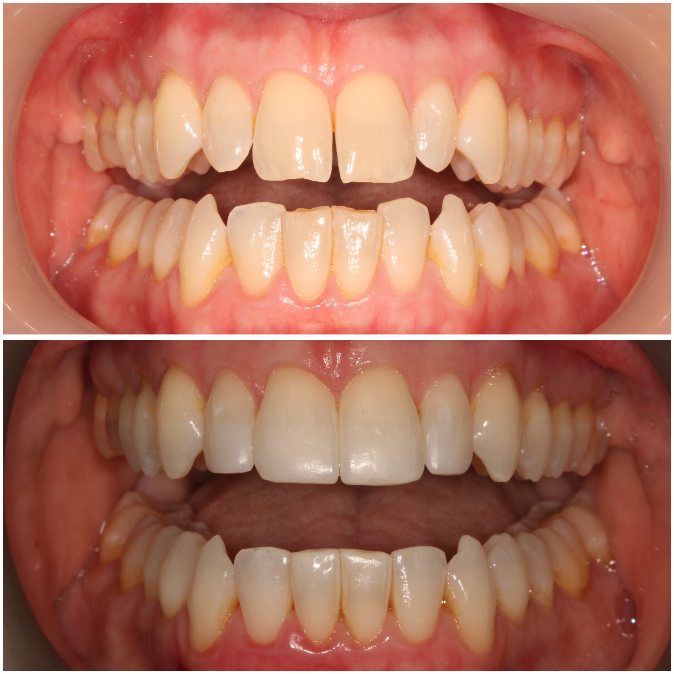 Teeth Straightening Marylebone