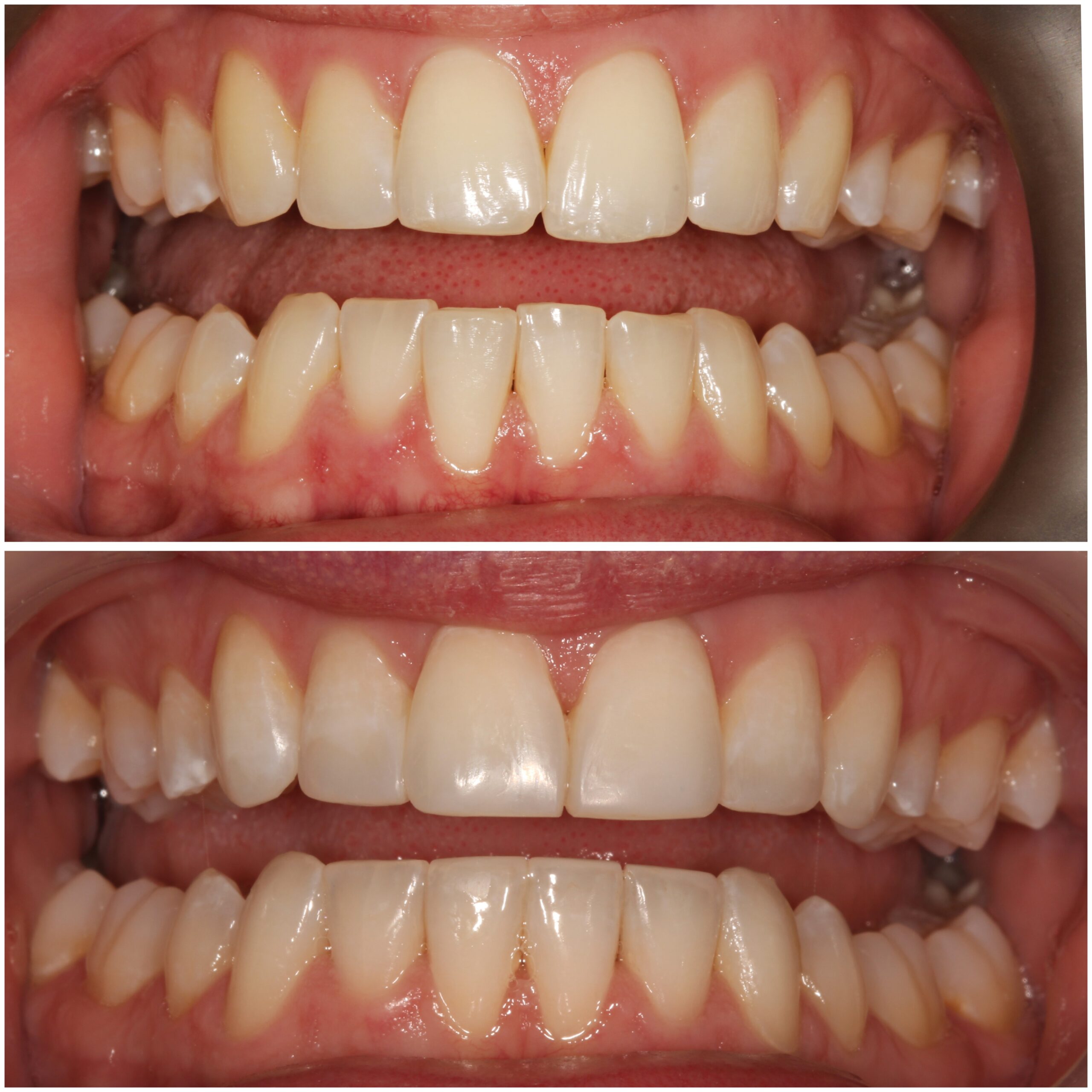 Teeth Straightening Marylebone