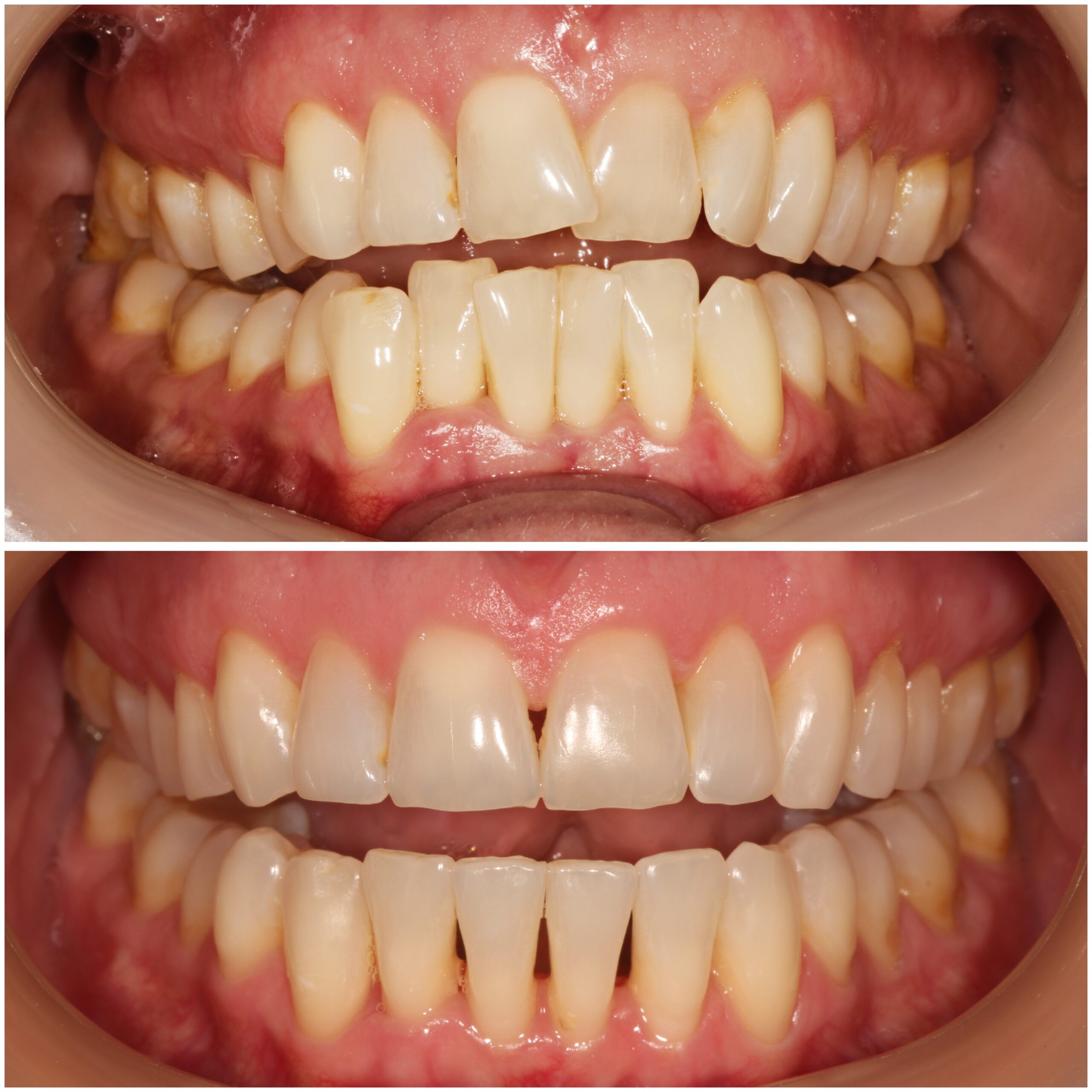 Teeth Straightening Marylebone