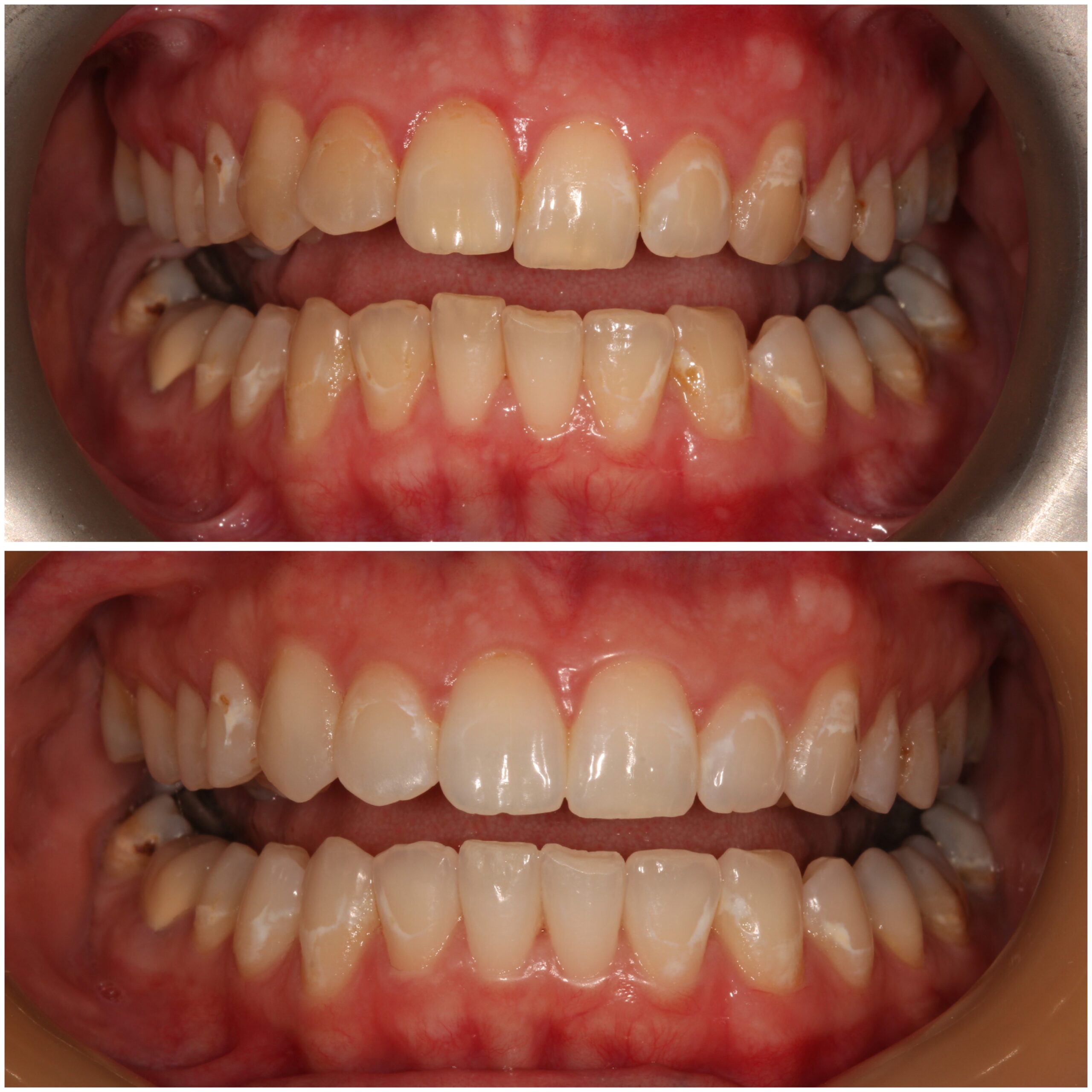 Teeth Straightening Marylebone