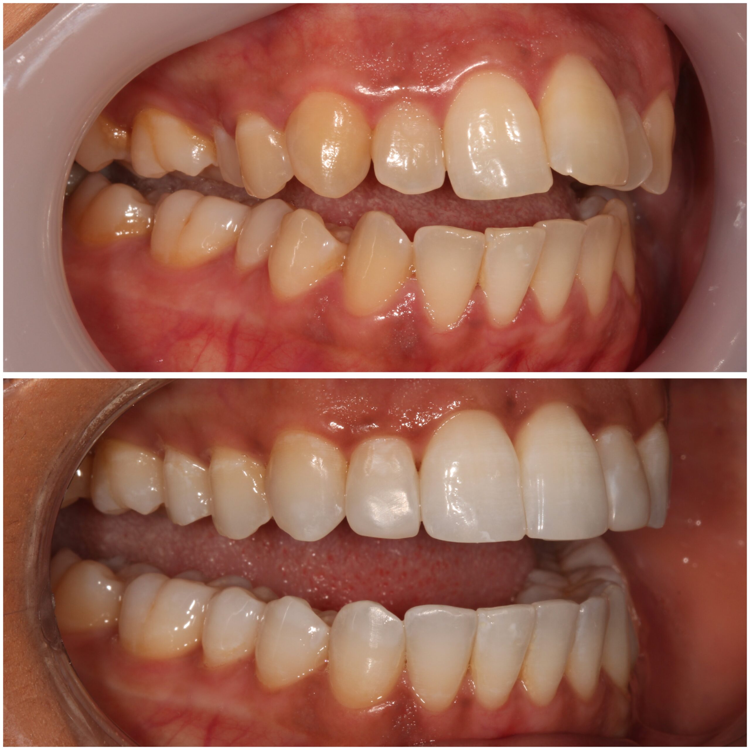 Teeth Straightening Marylebone