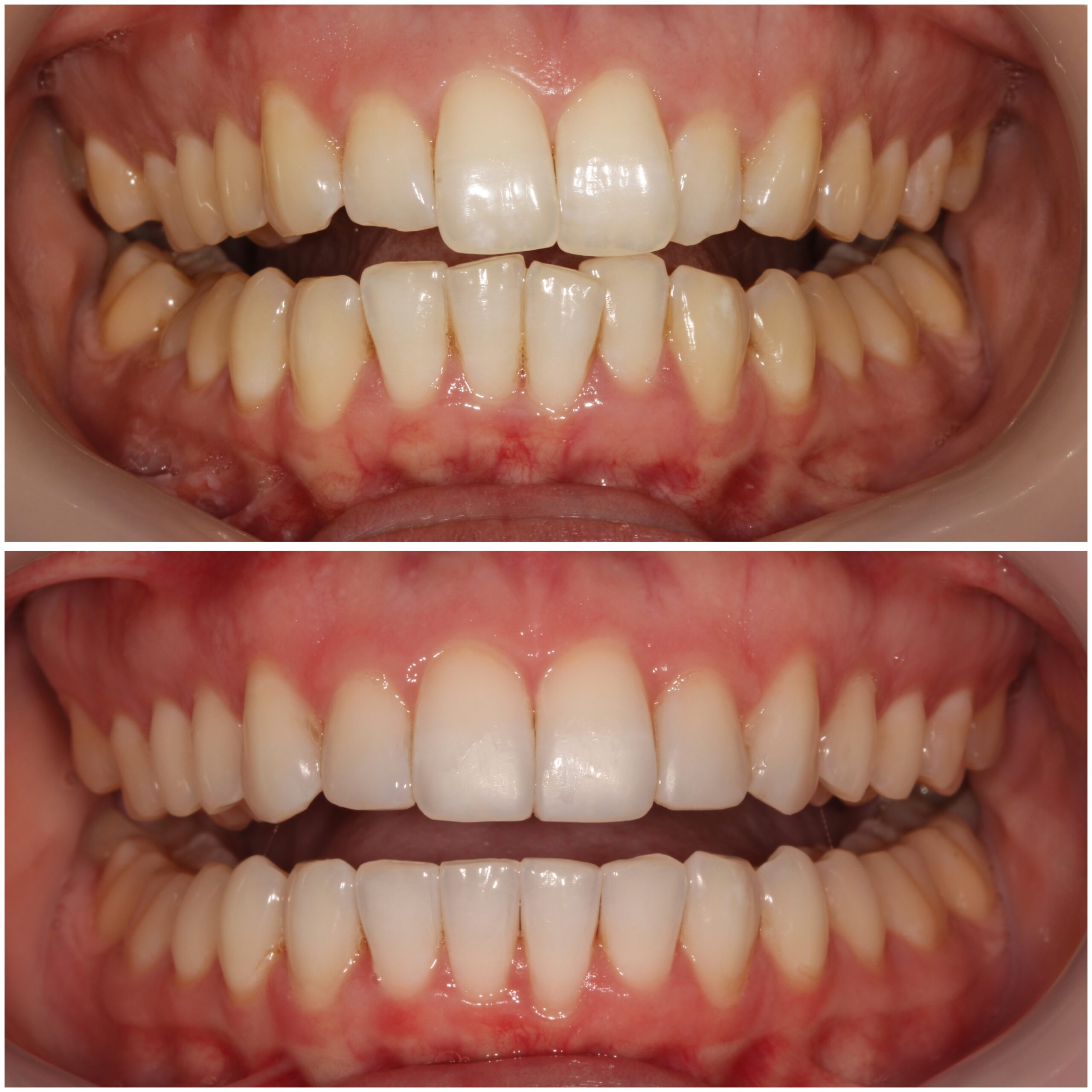 Teeth Straightening Marylebone