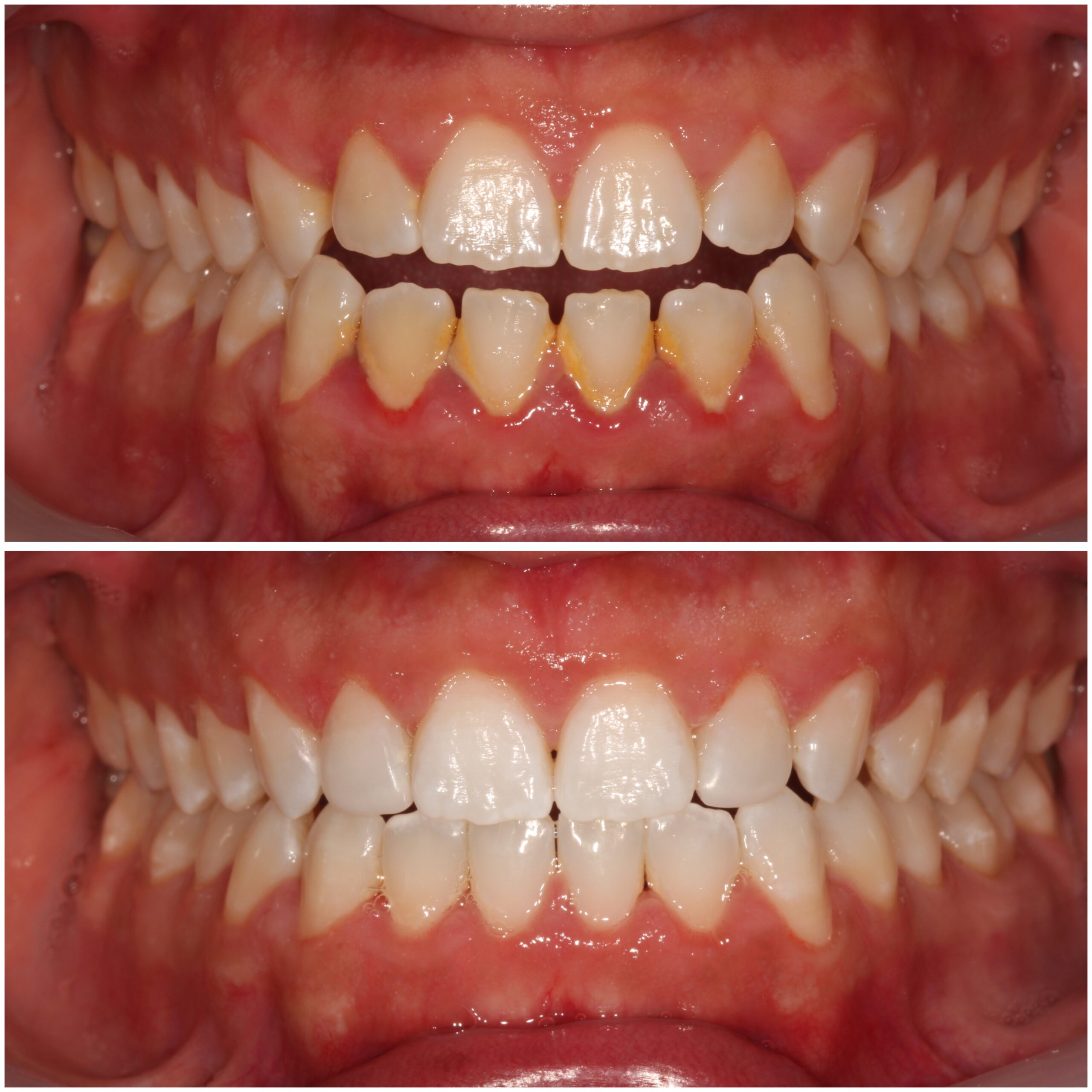 Teeth Straightening Marylebone