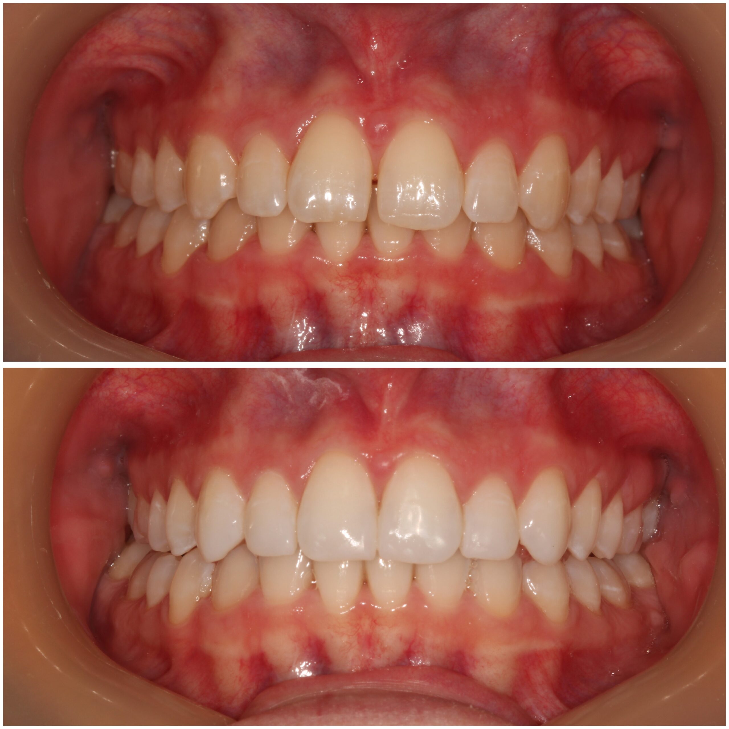 Teeth Straightening Marylebone