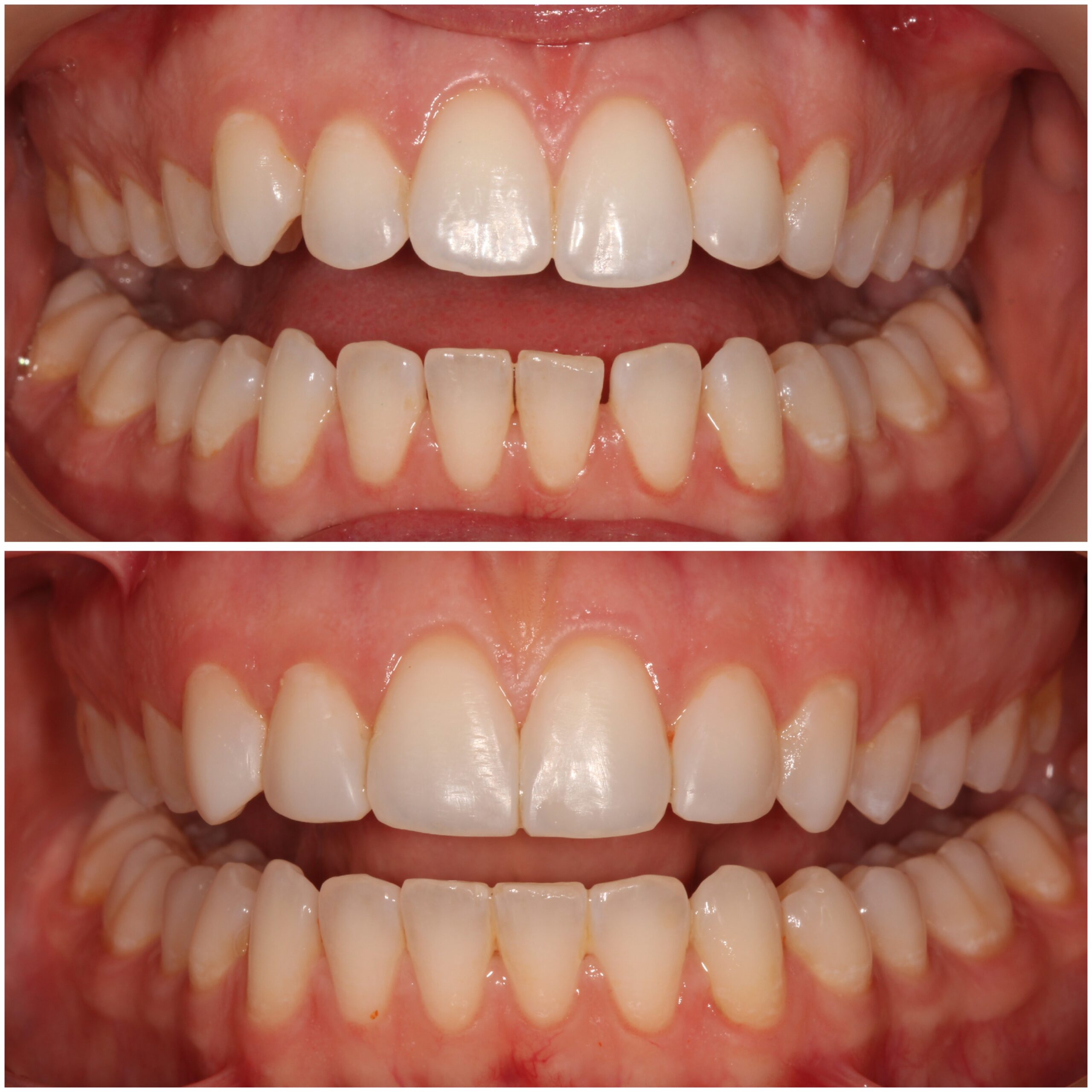 Teeth Straightening Marylebone