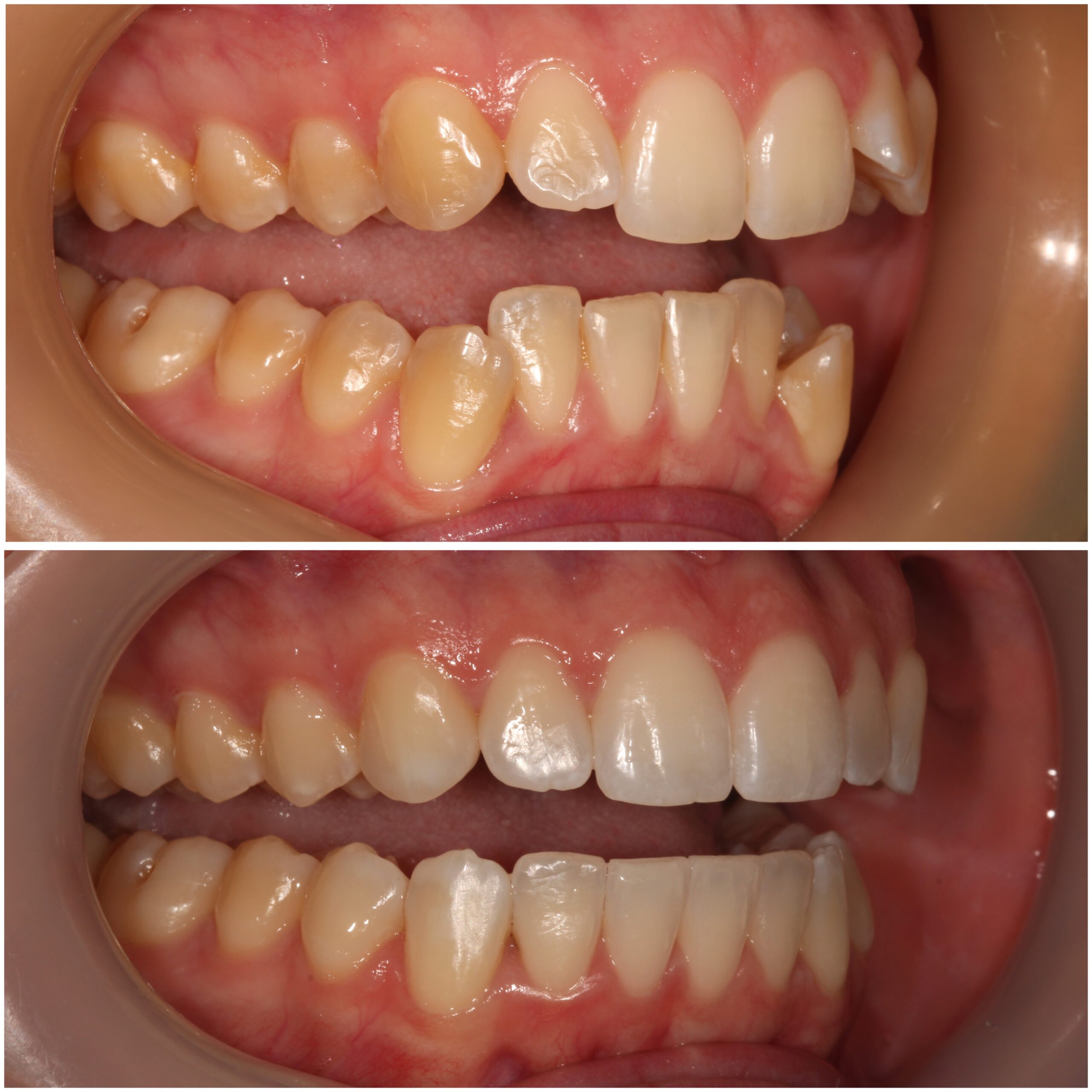 Teeth Straightening Marylebone