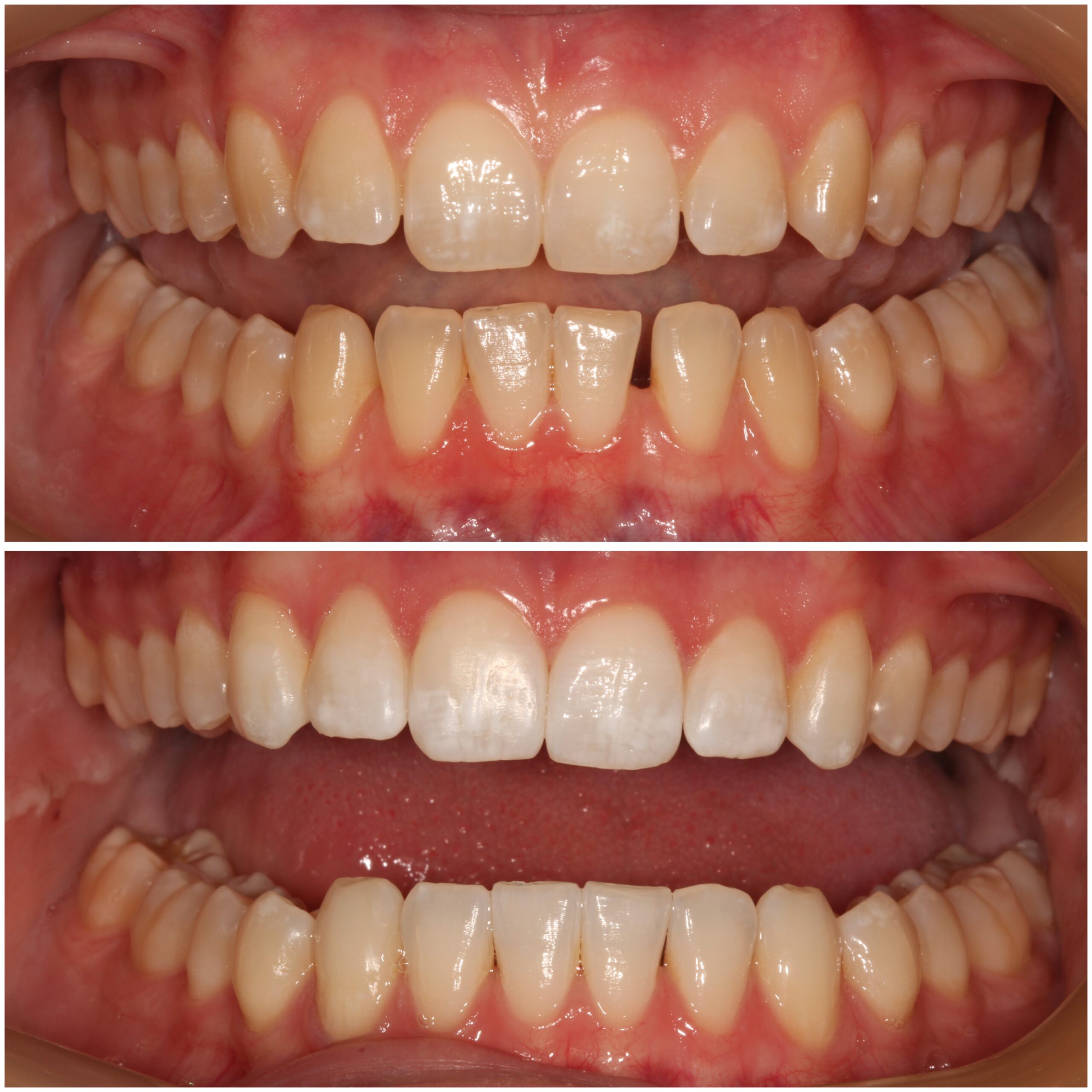 Teeth Straightening Marylebone