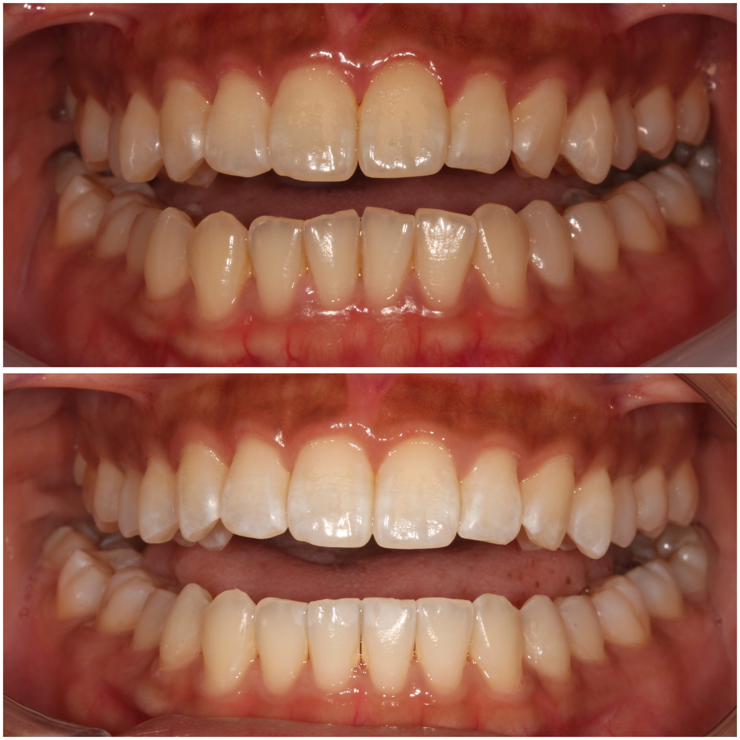 Teeth Straightening Marylebone