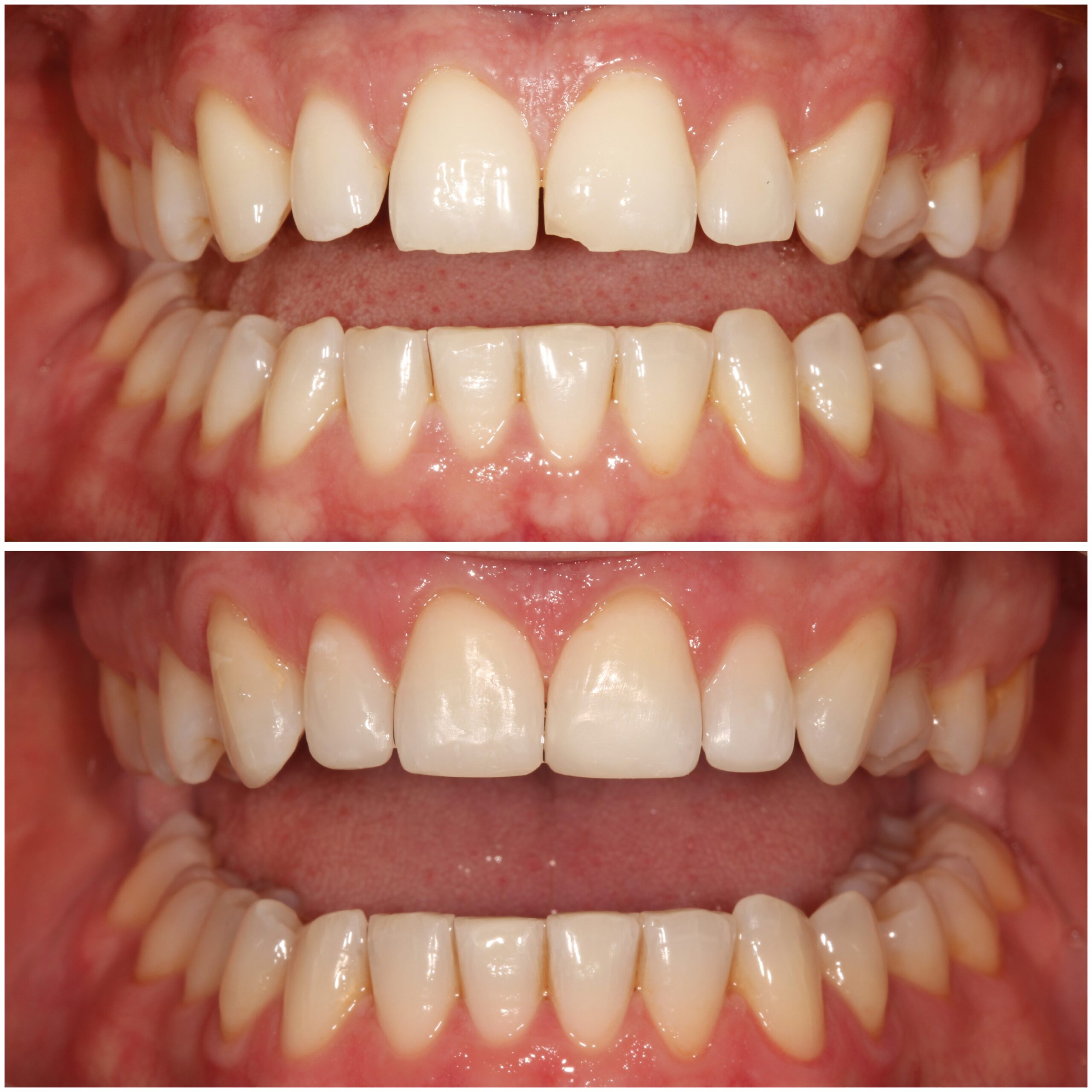 Teeth Straightening Marylebone