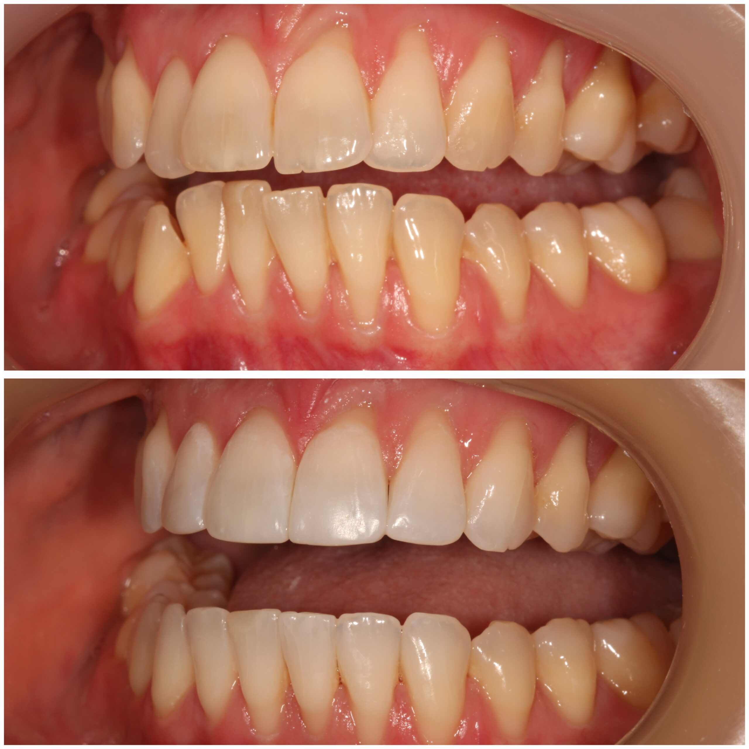 Teeth Straightening Marylebone