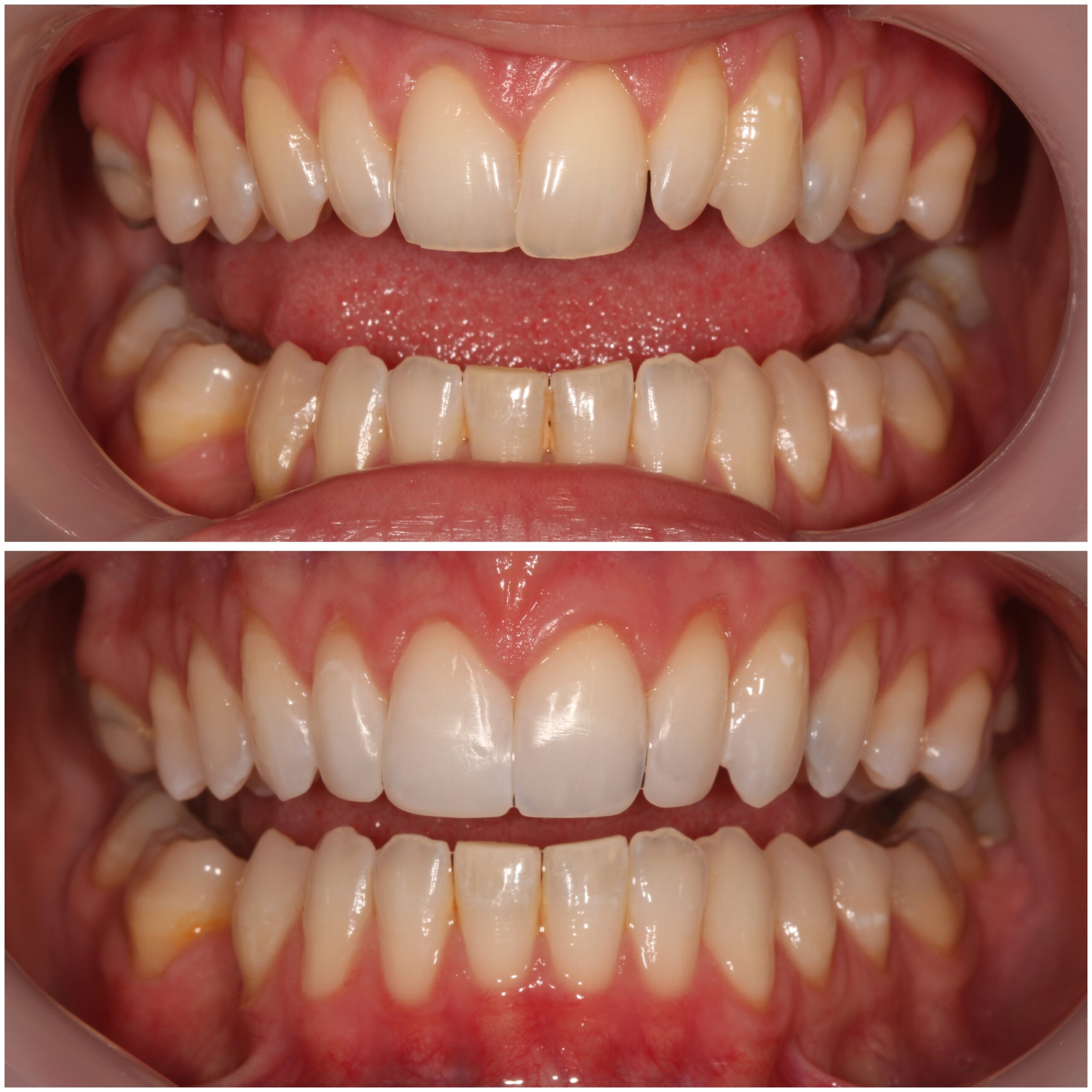 Teeth Straightening Marylebone