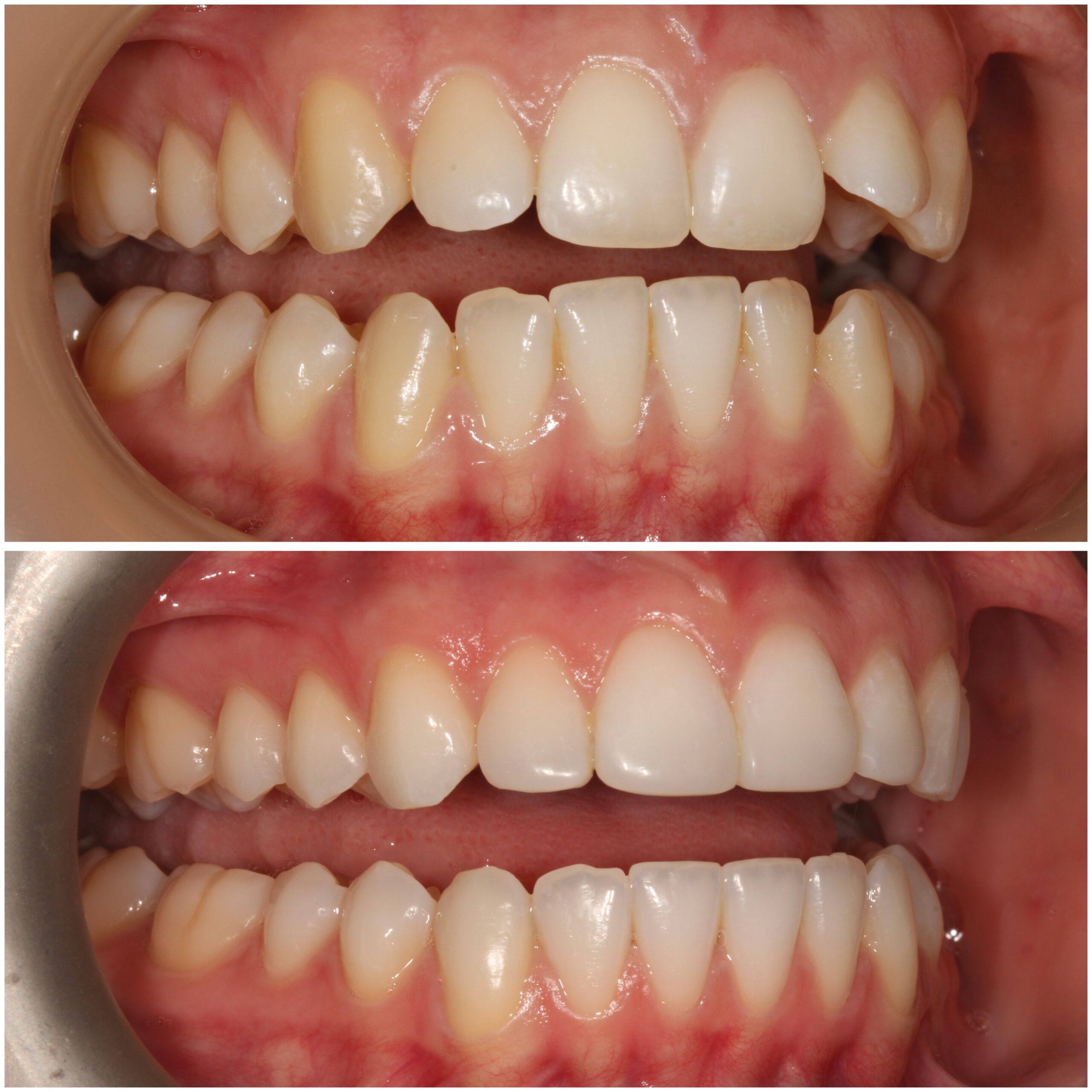 Teeth Straightening Marylebone