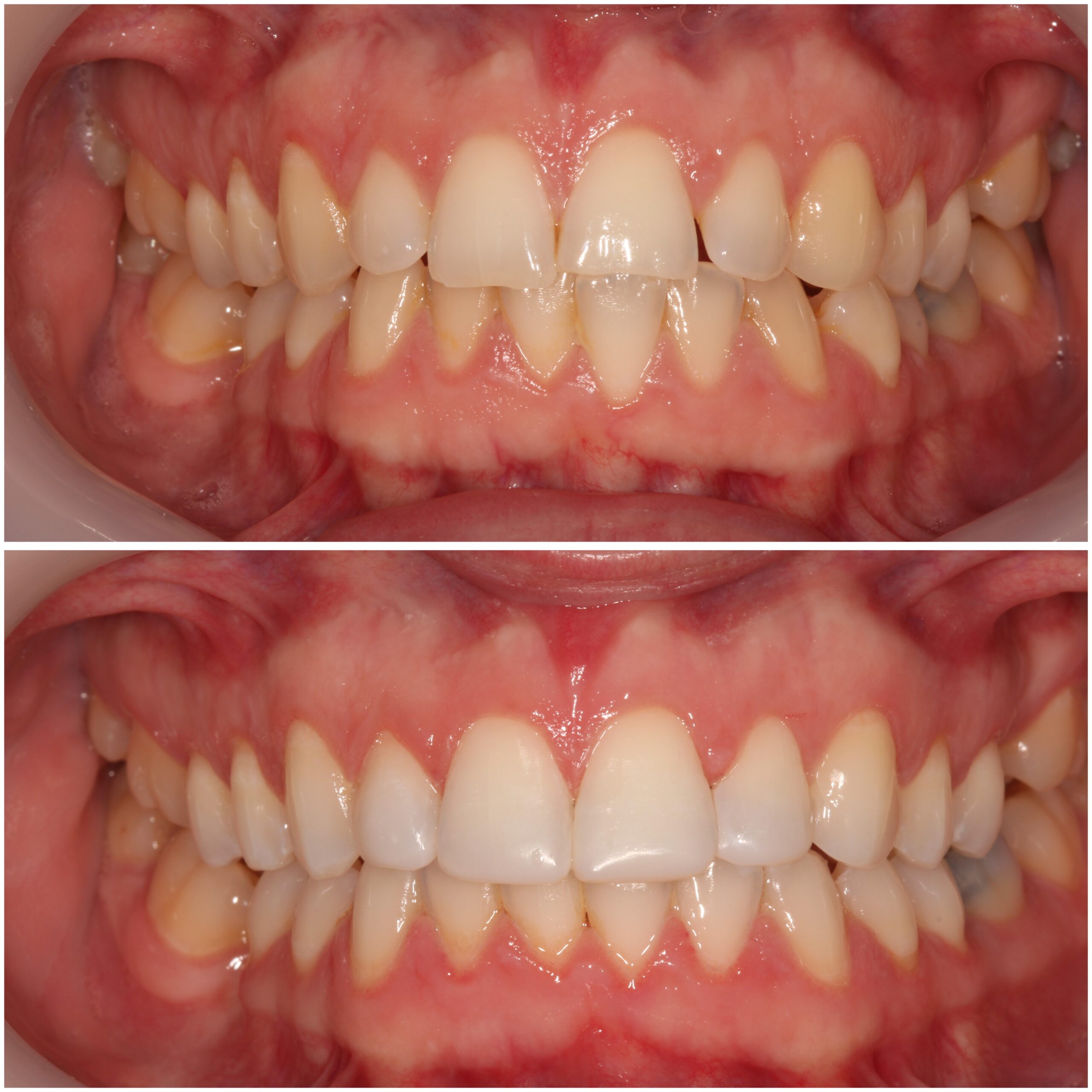 Teeth Straightening Marylebone