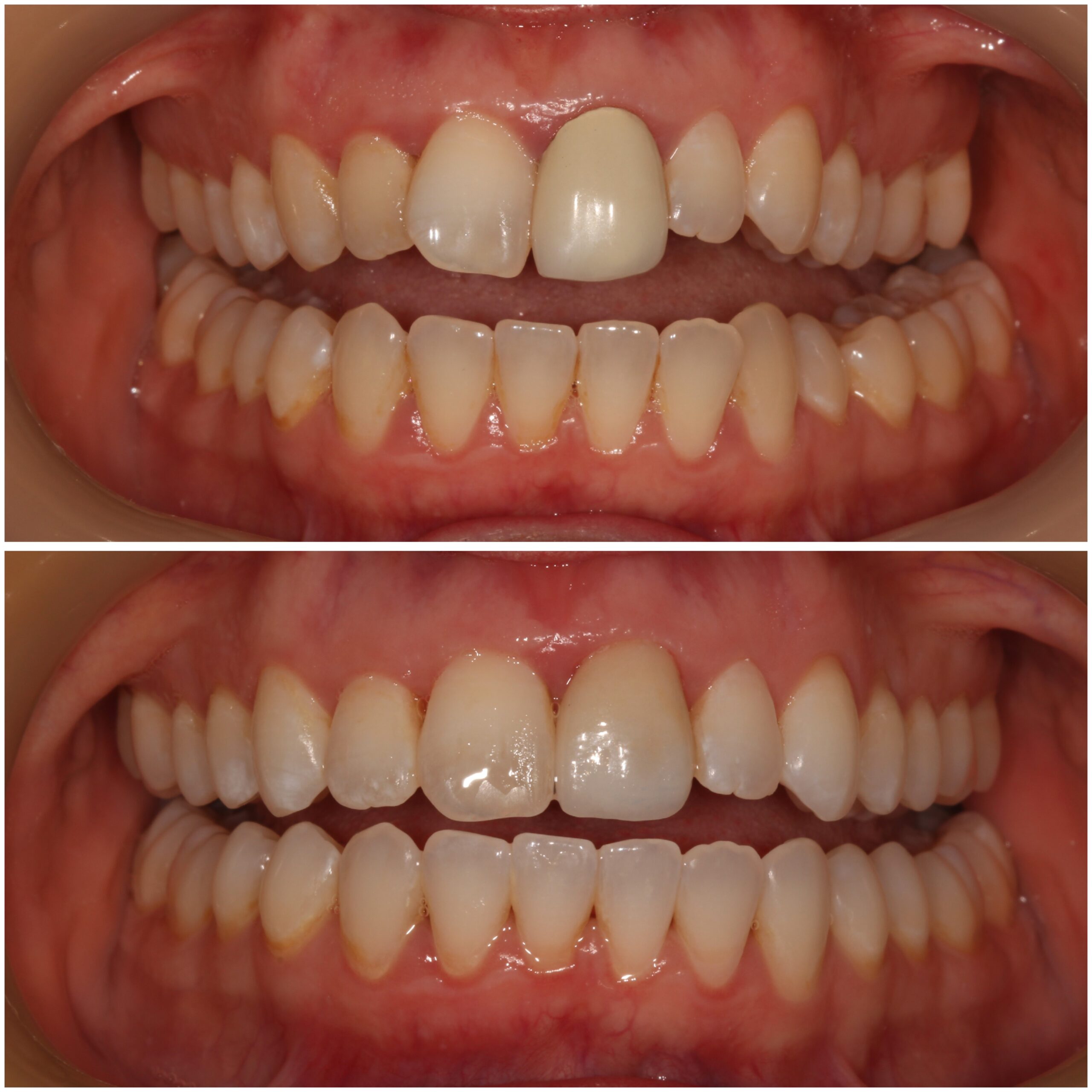 Teeth Straightening Marylebone